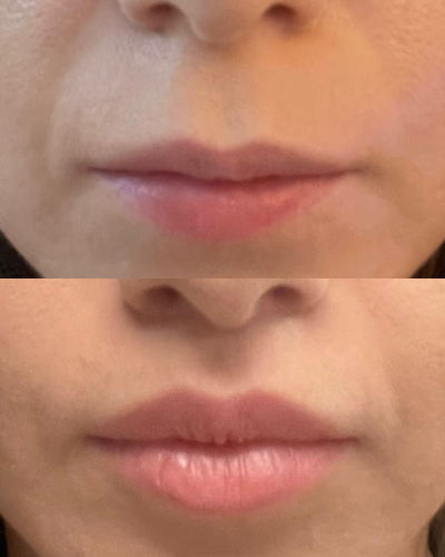 Bullhorn Lip Lift - Przed i Po