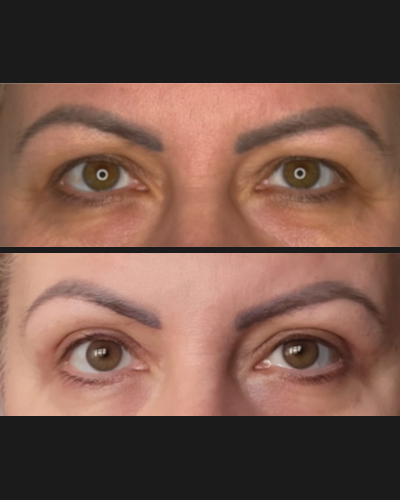Upper Blepharoplasty - Przed i Po