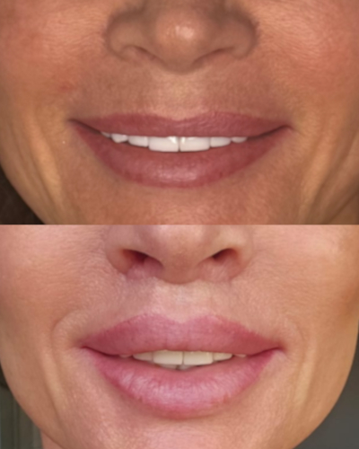 Cupid Lip Lift - Przed i Po